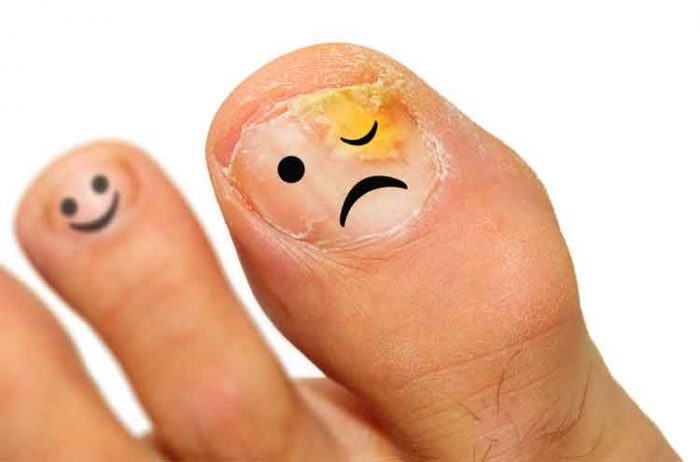 How to Get Rid of Ugly Toenail Fungus from Home