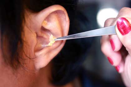 Best Home Remedies for Earwax Removal